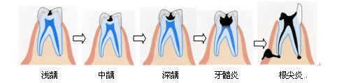 　　龋齿的发展过程