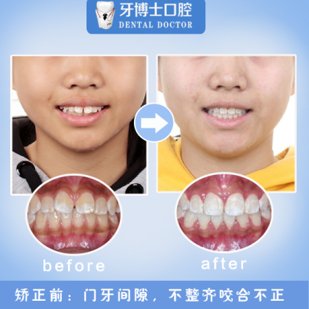 美团矫正5.jpg